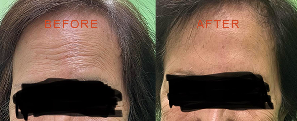 Wrinkle Reduction/Botox Treatment